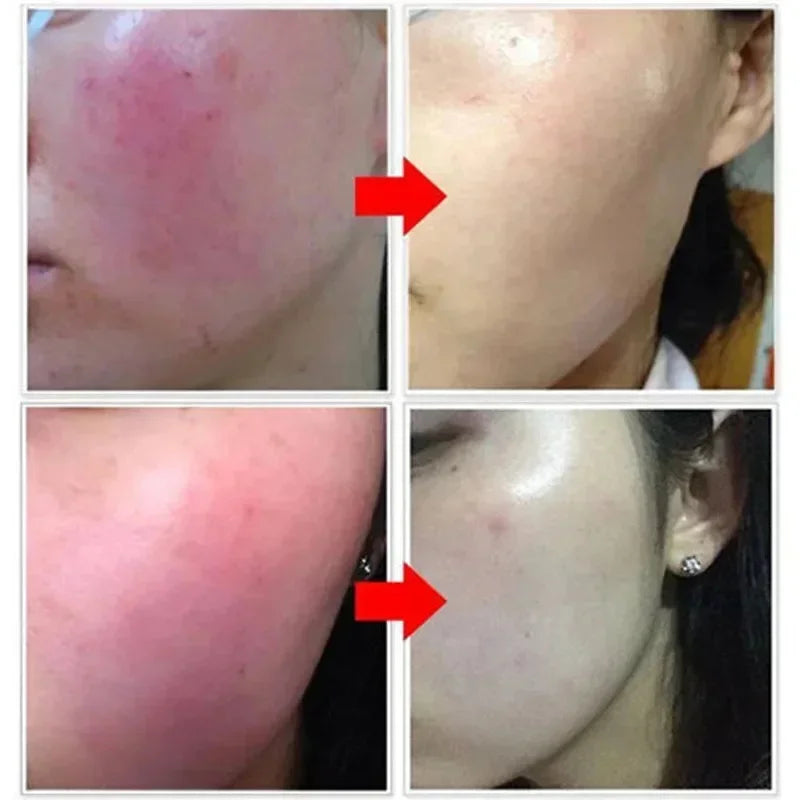 B5 Repair Facial Redness Cream Instant Spider Vein Remove Sensitive Skin Sooth Anti Redness Rosacea Treat Lotion Korean Cosmetic