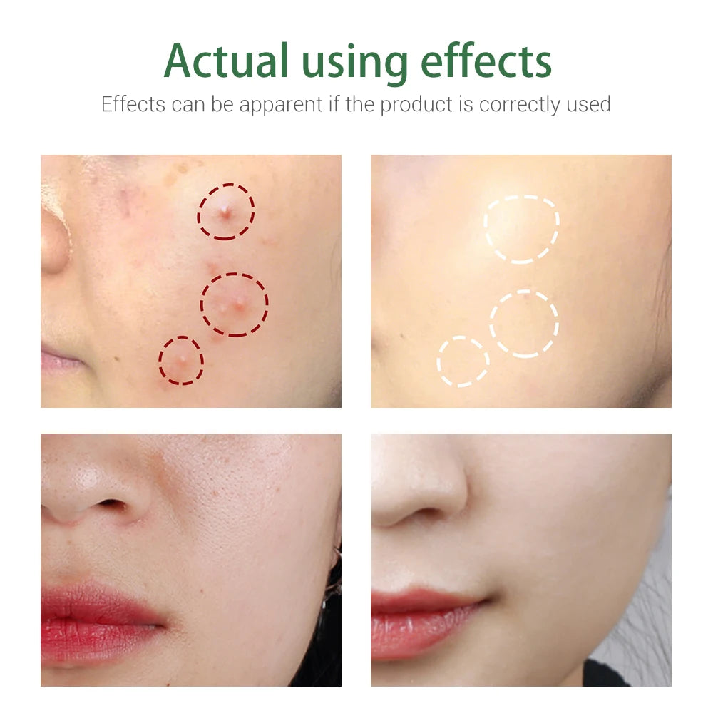 Your Daily Defense Against Acne and Blackheads: BREYLEE Cleansing Wash